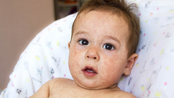 婴儿脸上长湿疹怎么办 婴儿脸上长湿疹是什么原因导致的