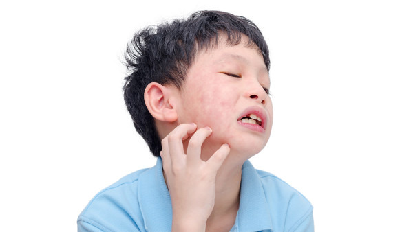 婴儿脸上长湿疹怎么办 婴儿脸上长湿疹是什么原因导致的