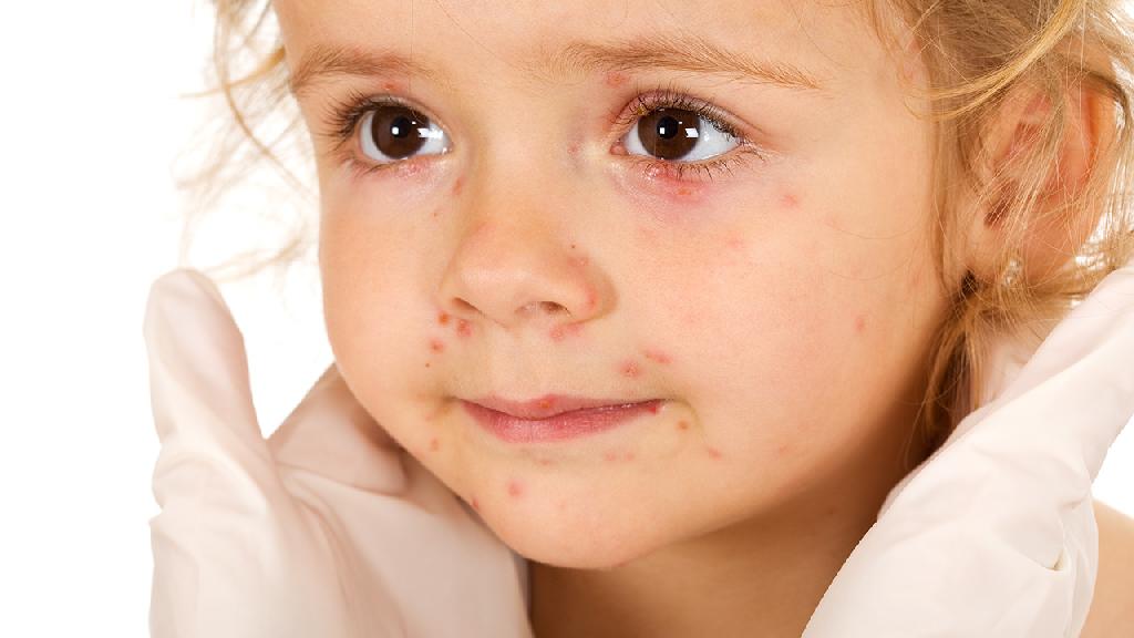 宝宝脸上长湿疹了怎么办 宝宝脸上长湿疹了的治疗方法有哪些