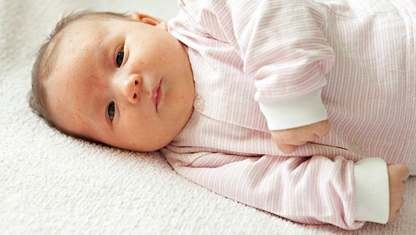 婴儿脸上有湿疹怎么办 婴儿脸上湿疹的治疗方法都有哪些