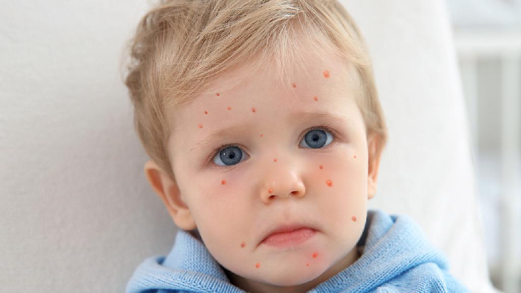 宝宝湿疹通常是什么引起的 宝宝湿疹的常见病因都有哪些