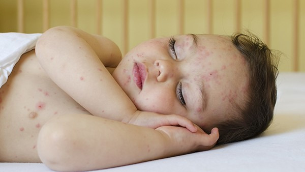 宝宝湿疹最佳治疗方法是什么 宝宝湿疹使用冷湿敷管用吗
