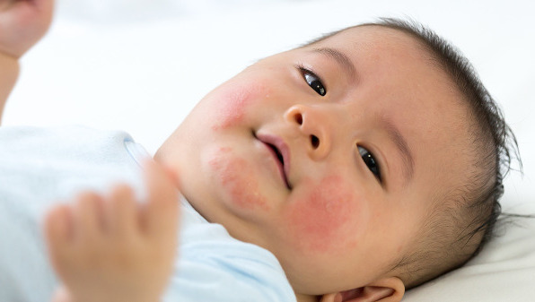 宝宝湿疹用什么药最好 宝宝湿疹用药需要注意什么
