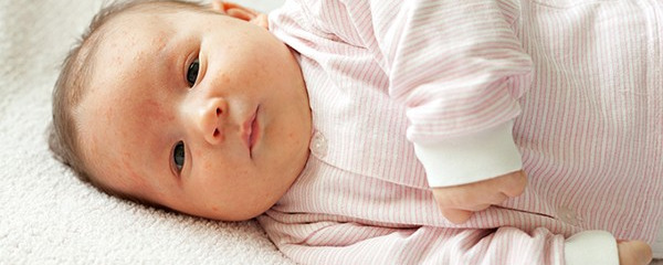 新生儿红屁股怎么治疗 应对新生儿红屁股的4个有效方法