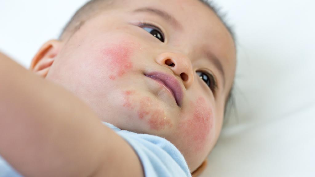 日常护理做得好帮宝宝摆脱湿疹 教你三个小技巧