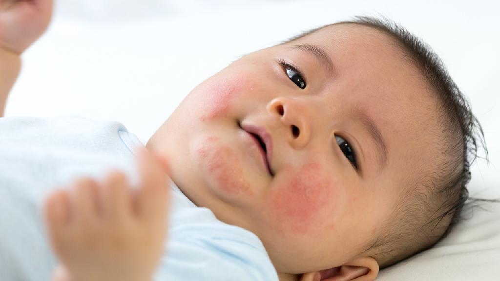 宝宝长湿疹不仅可以药物治疗还能饮食治疗 来看看具体方法怎么做