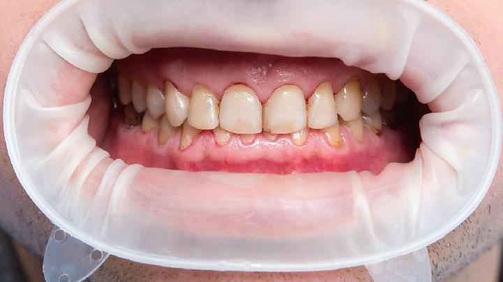 人类牙齿为何如此脆弱？原因在这儿