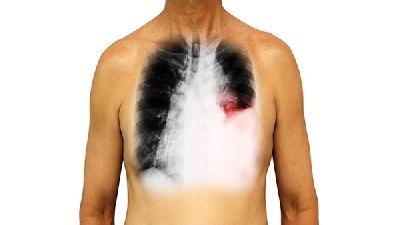 体检查出肺部磨玻璃样结节，就是肺癌？