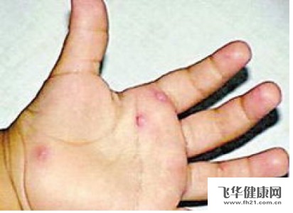孩子发烧没有别的症状