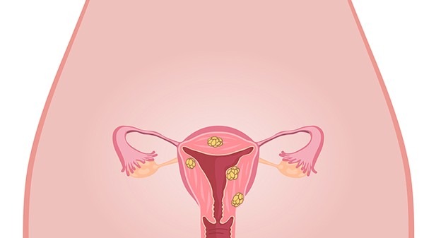 子宫颈癌是什么