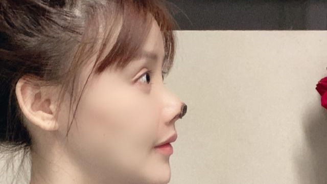 震驚！演員高溜整容失敗鼻尖壞死 職業(yè)生涯或到此結(jié)束