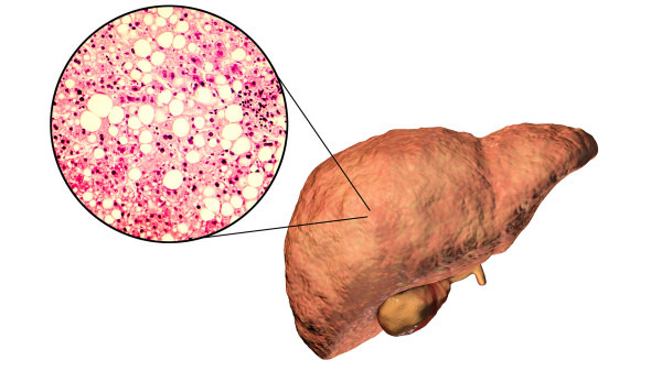 脂肪肝有囊肿可能传染吗