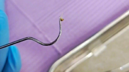 草莓籽竟然在牙缝里发芽了 牙缝清洁到底有多重要