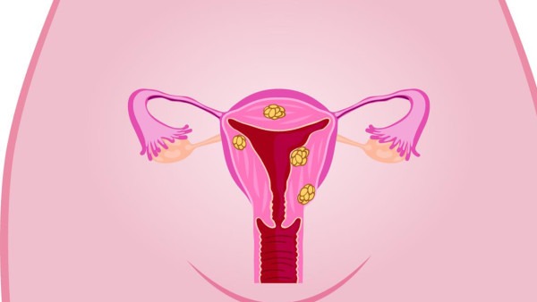 女性子宫内膜癌发病率近20万，病因与8大因素有关
