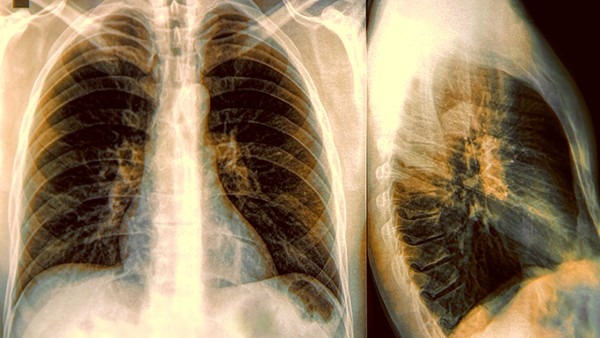 小细胞肺癌的早期症状，4种症状最常见