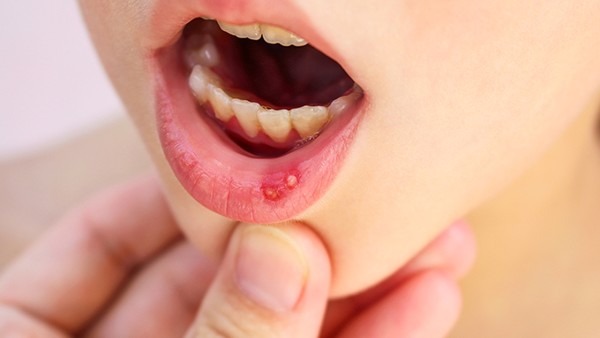 儿童唇炎的症状有哪些图片
