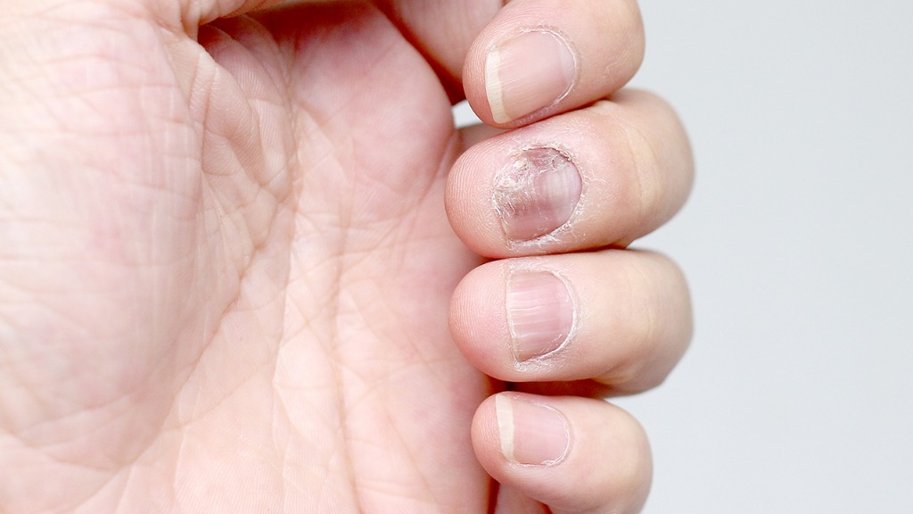 指甲有横纹是大病吗，指甲上出现横纹可能预示5种病