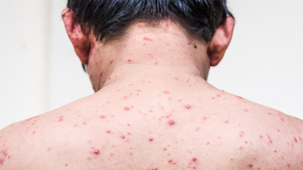 背上长痘痘首先要确定痘痘的类型,一般可能是毛囊炎或者是痤疮,对于