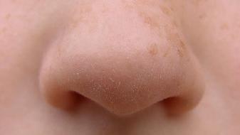 隆鼻失败造成鼻孔一大一小能修复吗?