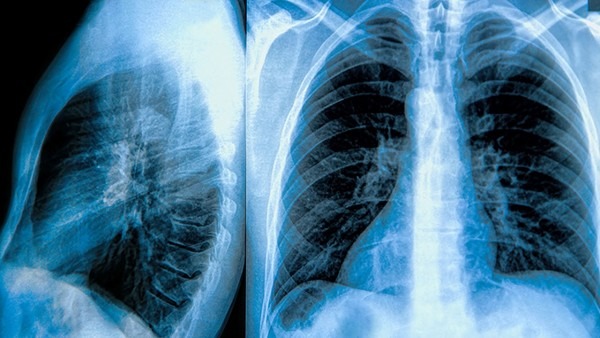 专家详解新冠肺炎疫情与非典型肺炎的区别