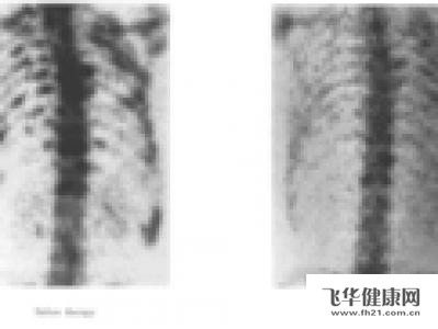 为什么会得肺癌骨转移 o4YBAFRtWIWABvZ6AAA-NKW9FlY663.jpg