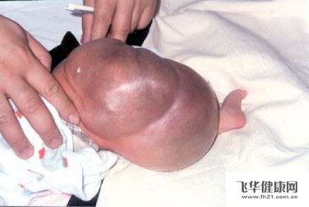 男性畸胎瘤图片