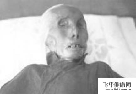 老年人脱水是什么原因引起的