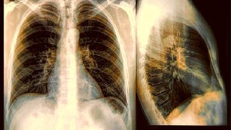 诊断新冠肺炎的医疗手段是什么 查新冠查出肺癌怎么办