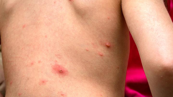 生殖器疱疹的因素是哪些  常见的症状是什么