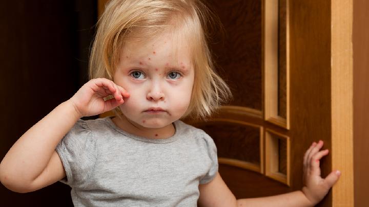 孩子皮肤长湿疹要找到病因  家长该怎么做好预防