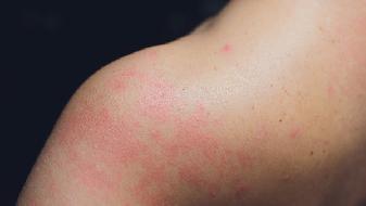 说到皮肤病多数是药疹的问题  药疹患者日常需要哪些预防