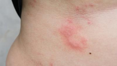 荨麻疹对肌肤的损害要做好预防 试试这些偏方
