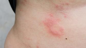 不同人患有带状疱疹的症状不同   如何预防呢？