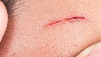 擦伤割伤怎么处理，应对不同伤口的正确方法