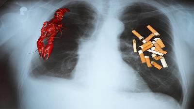 X光胸片并不能早期发现肺癌