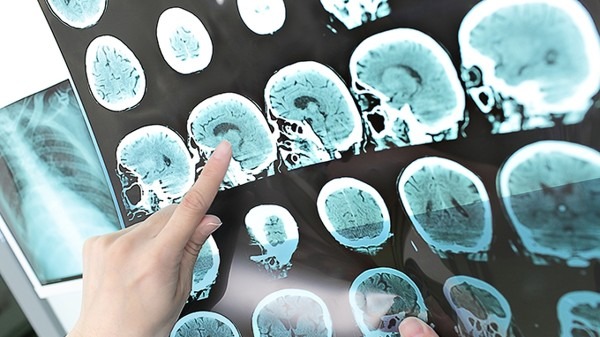 除了感冒,嗓子嘶哑疼痛还可能是头部肿瘤信号