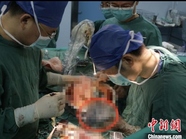 64岁男子成功换肺！江西首例肺移植手术在省医院顺利完成