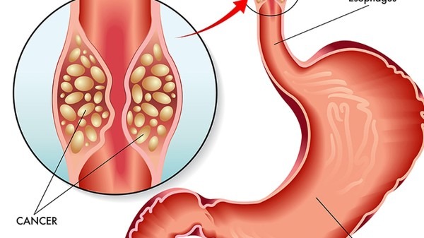 胃黏膜怎么就萎缩了？胃黏膜为什么会损伤