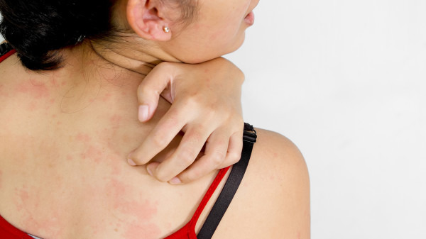 湿疹能自行治愈吗 治疗湿疹的3个常见疗法