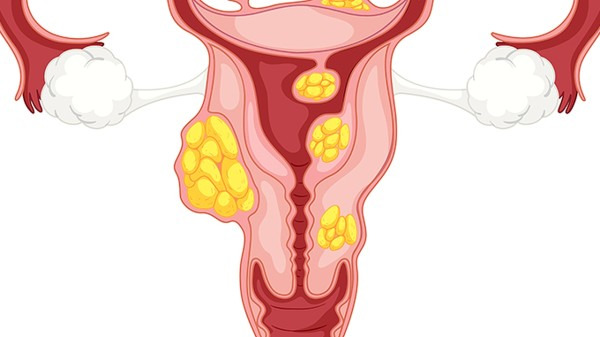 卵巢肿瘤卡通图片