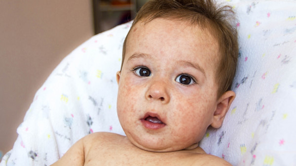 小儿湿疹作为常见的皮肤病 会给孩子带来什么影响