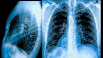 暑期返程如何预防肺炎？复工如何预防新冠肺炎