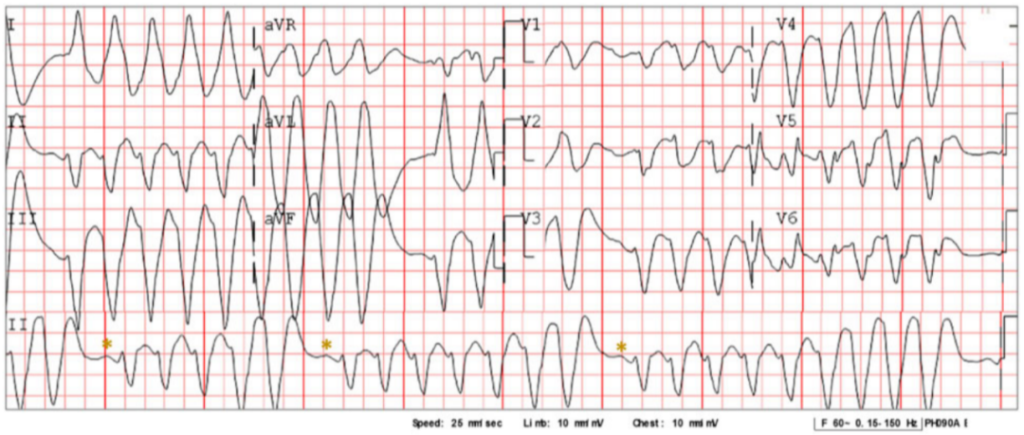 研究发现喝枸杞茶或可引起心血管药物氟卡尼和华法林中毒