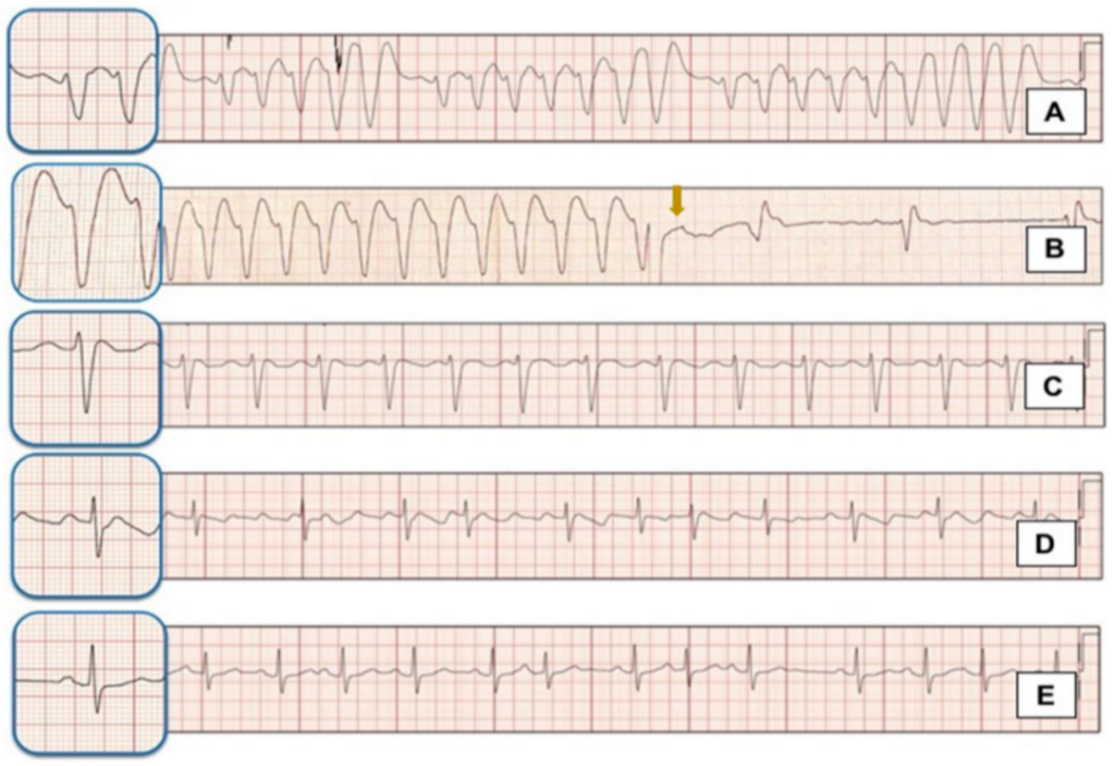 研究发现喝枸杞茶或可引起心血管药物氟卡尼和华法林中毒