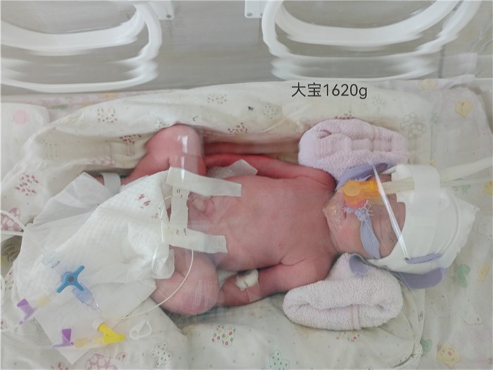 母子平安！全国首例新冠肺炎确诊三胞胎孕妇在瑞丽顺利生产，核酸检测均为阴性