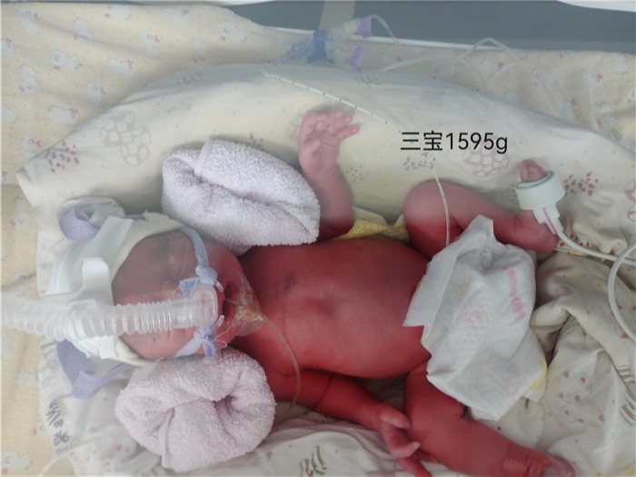 母子平安！全国首例新冠肺炎确诊三胞胎孕妇在瑞丽顺利生产，核酸检测均为阴性