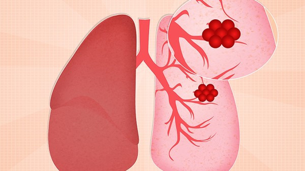肺癌早期的5大症状  肺癌的4大饮食禁忌