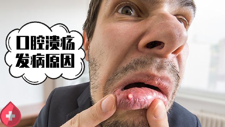 女性月经前口腔溃疡更易复发
