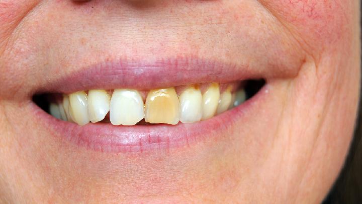 洗牙不正确易导致其他症状