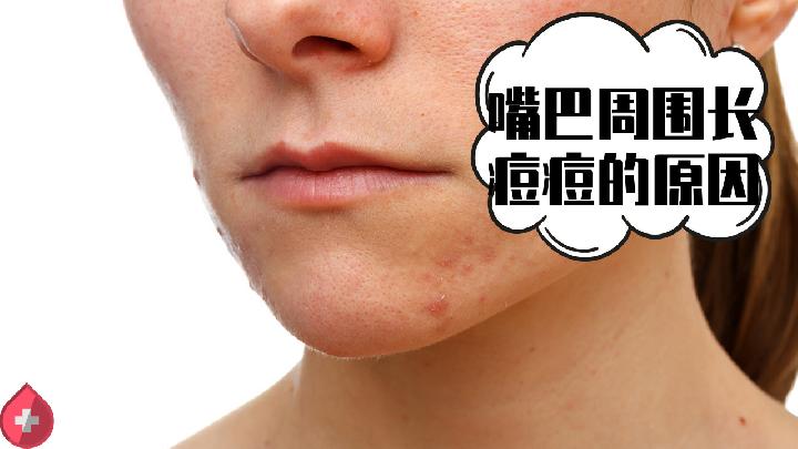 脸上长痘痘的原因 导致脸上长痘的原因是什么